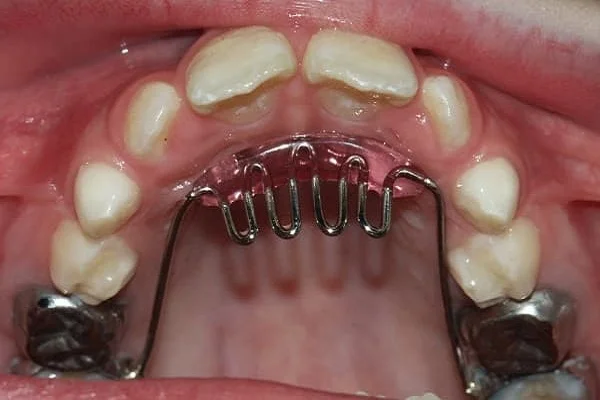 habit breaking appliance