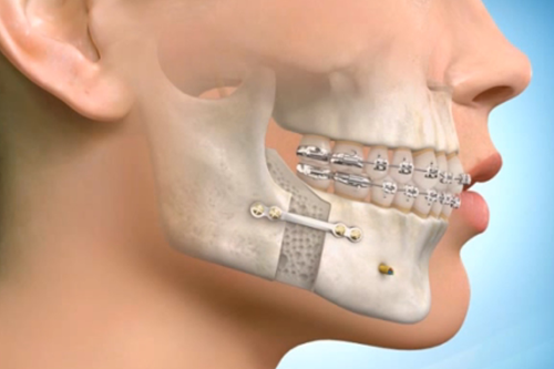 orthognathic surgery jaw surgery