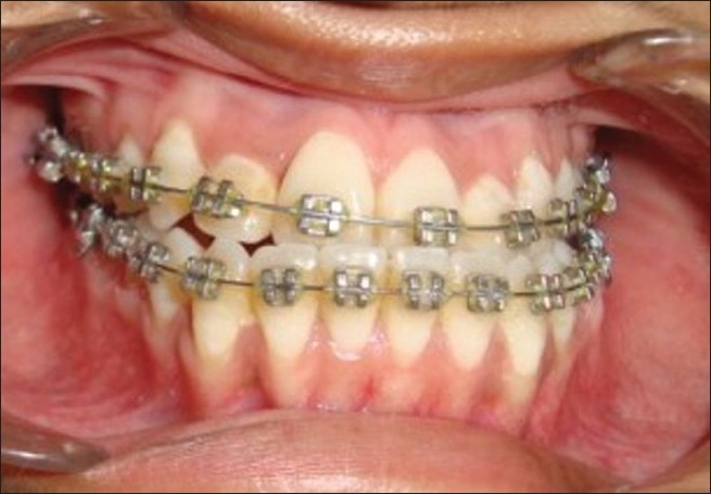 presurgical orthodontics intraoral frontal view