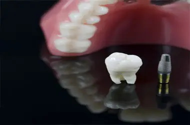 extraction for implant