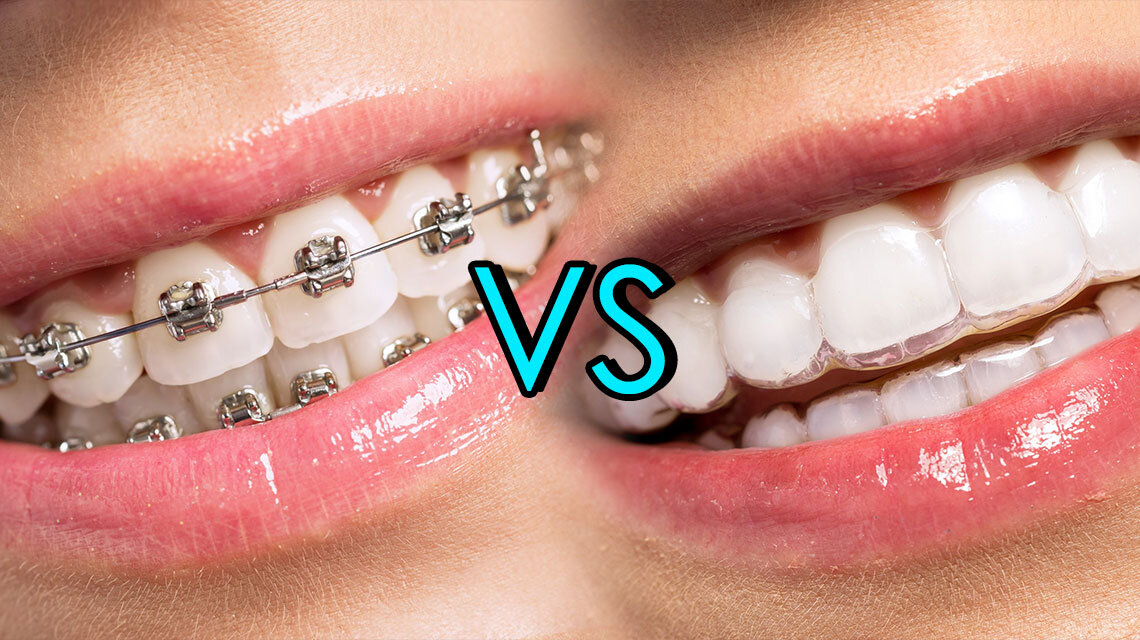 invisalign vs braces
