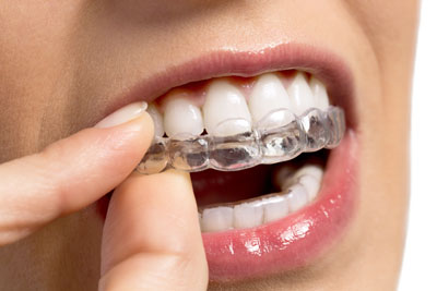 invisalign20172